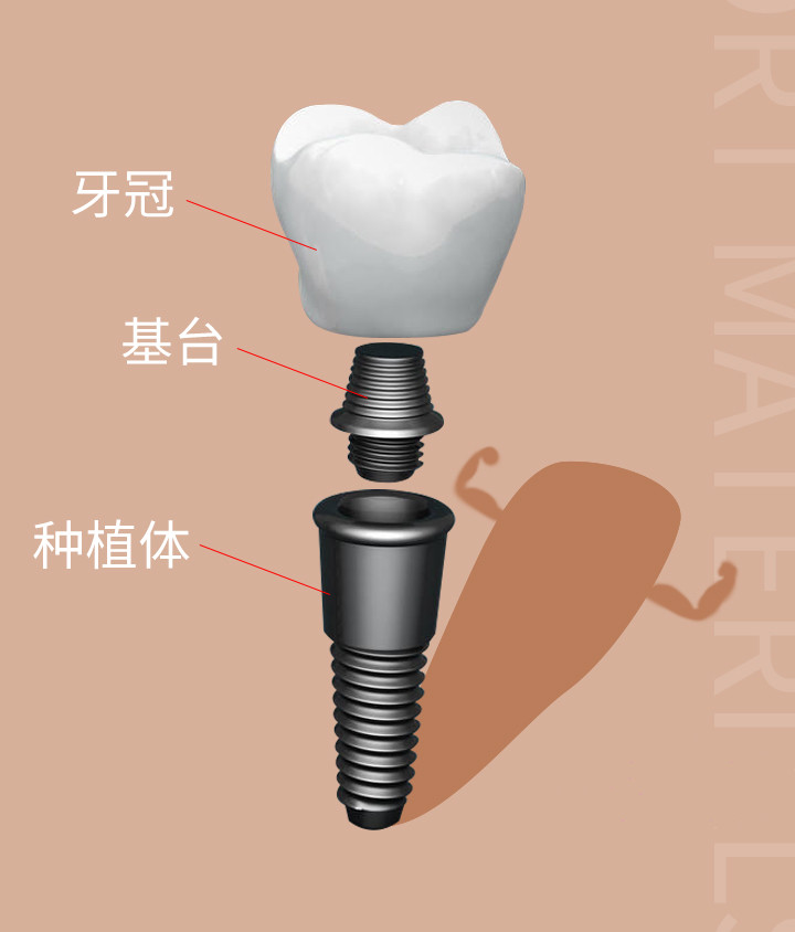 種植牙結構圖